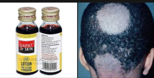 Sapat lotion for ring worm