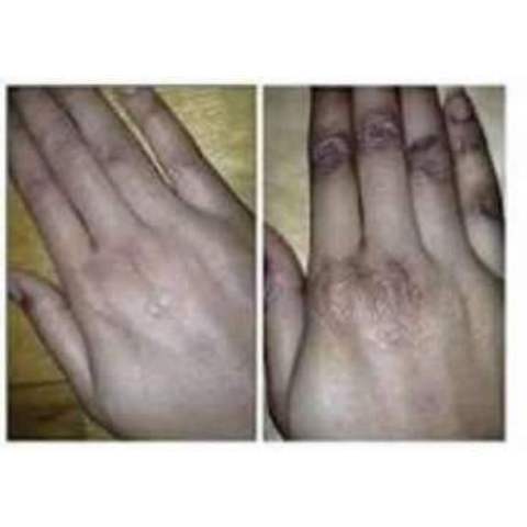 Get Rid of Dark Knuckles