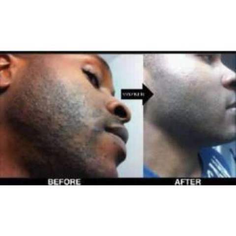 After Shave Pimples and Zits Remover by Acne Care Kenya